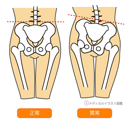 意識してないと使わない脇腹 腰痛にも関わる トレーニングで骨盤や姿勢の安定につながります 広島市中区で整骨院をお探しならフォームconditioning整骨院